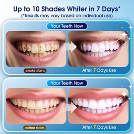 Teeth Whitening Kit – 3 Teeth Whitening Pens + 2 Desensitizing Pens – LED Light – 35% Carbamide Peroxide – Safe & Dentist-Recommended – Fast 7-Day Visible Whitening + Remineralizing Care（Yuzu Citrus）