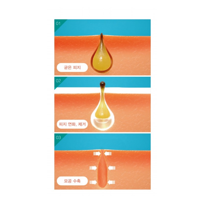 Hickstein [Hickstein] Deep Sebum Softening Extractor Sebum Removal Blackhead Care