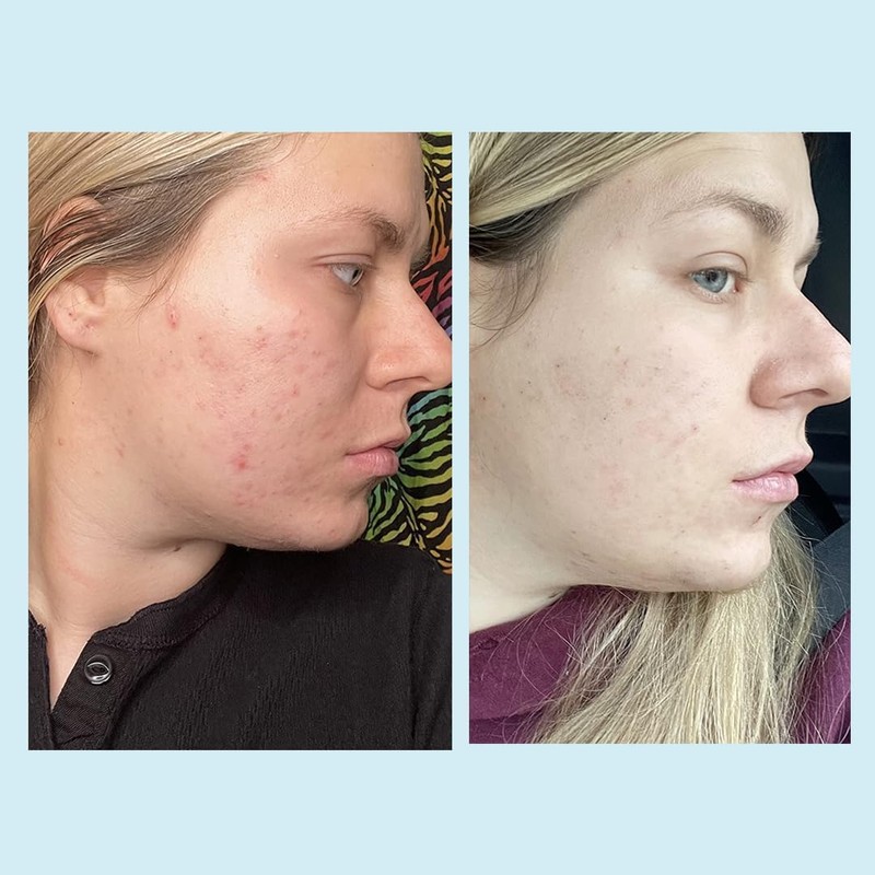 Salicylic Acid 20% Gel Peel - Enhanced with Tea Tree