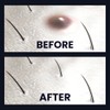 Ingrofix by BioClear - Ingrown Hair Treatment, Perfect for Legs,