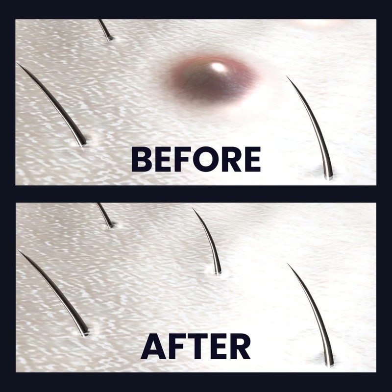 Ingrofix by BioClear - Ingrown Hair Treatment, Perfect for Legs,