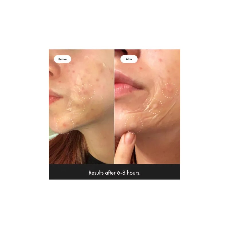 Parche para Acné Mighty Patch Surface XL 10 Piezas Hero