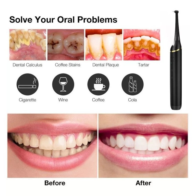 Cuidados De Clareamento E Ferramentas De Remoção De Tártaro