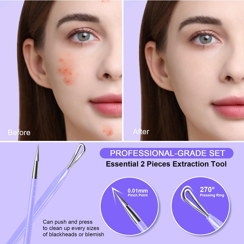 Teenitor Pimple Extractor Acne Treatment Tool Blackhead Comedone Removal 2-in-1