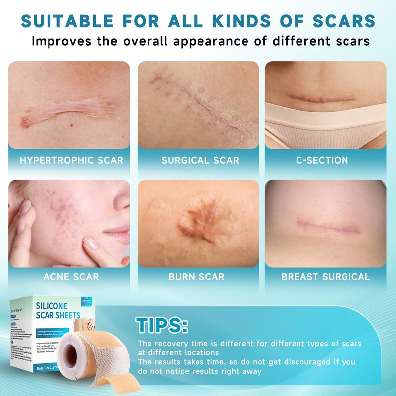 Silicone Scar Sheets, Silicone Scar Tape(1.8”x 157” Roll-4M), Silicone Scar