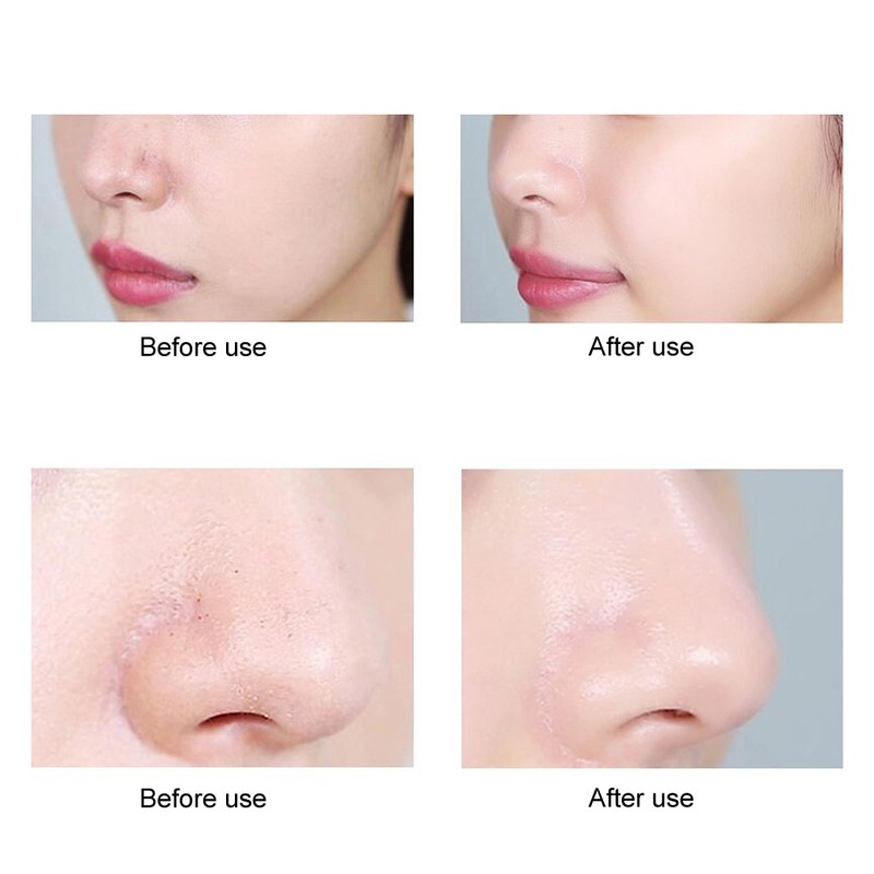 Ultrasonic Skin Scrubber Blackhead Removal Exfoliating Face Massage Pore Cleaner
