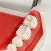 10 pcs/Pack Dental Clear Matrix Anterior Posterior Fit Bioclear BT