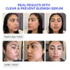 Murad Biome-Balancing Serum - Suero Facial Anti-Imperfecciones con Ácido Salicílico,
