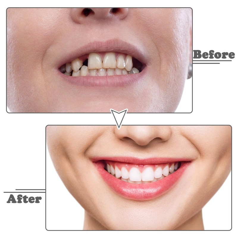 Clip in Veneers Teeth, 1 Pairs Snap on Veneers False