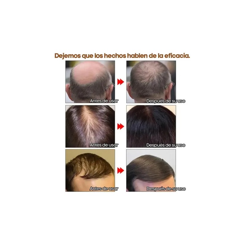 Andrea Solución Crecimiento Regenera Detiene Caída Cabello F Full