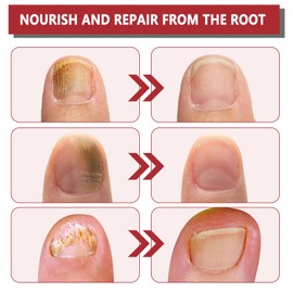 2PCS Ginger Nail Treatment – Nail Growth Serum & Cuticle Care Oil, 7-Day Nail Repair & Strengthener, Nourishing Nail Nutrient Oil for Healthier, Stronger Nails 2 Fl Oz (Pack of 2)