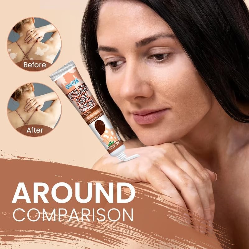 Vitiligo Cream, Natural Effective Vitiligo Treatment for Reduce White Spots