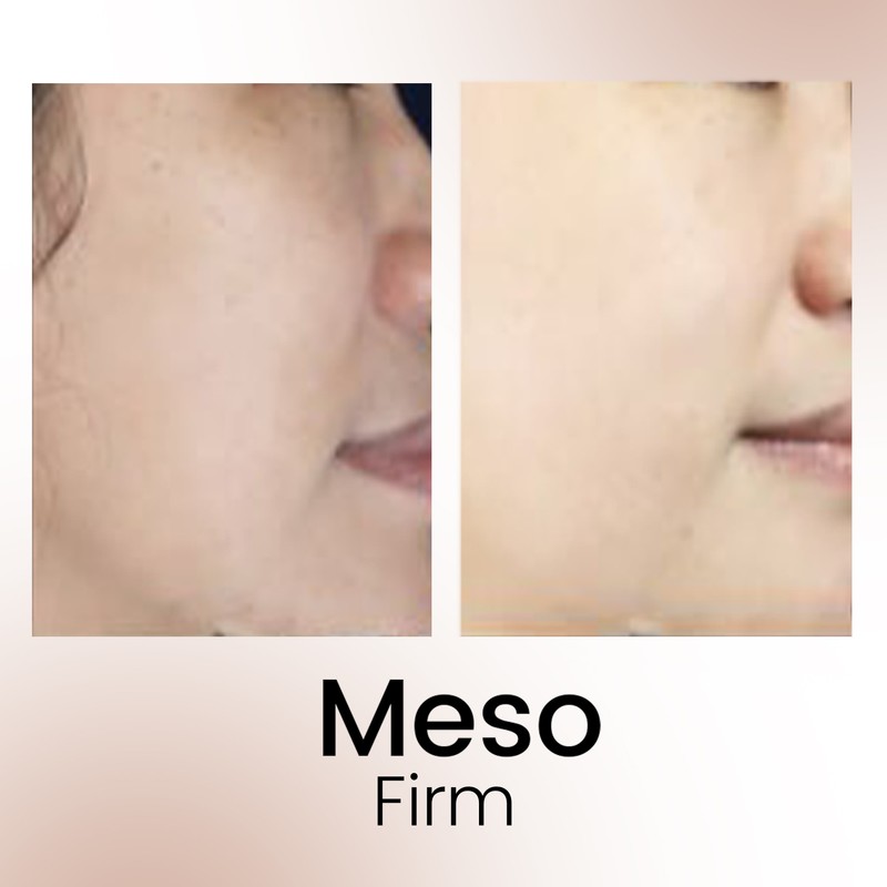 Relumins Intense Glow Meso Firm Serum Set