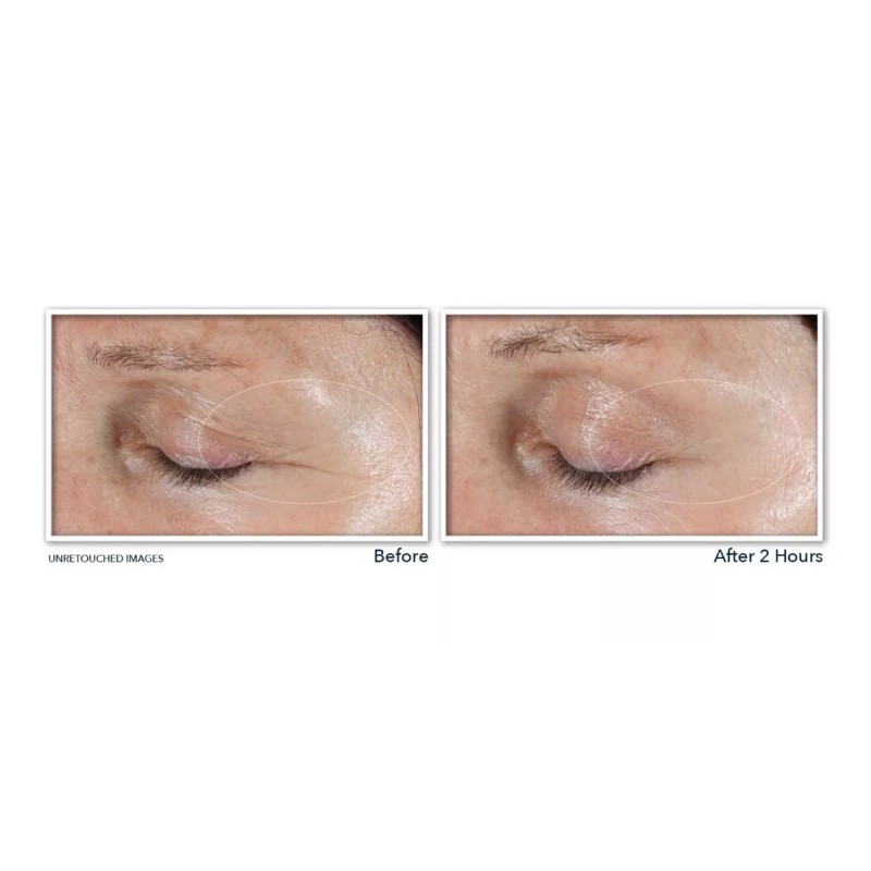 Roc Retinol Correxion- Parches Dirigido No Invasivos Arrugas