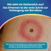 ADESTE BORRELIOSE TEST TICKS - Quick Self Test for Diagnosis