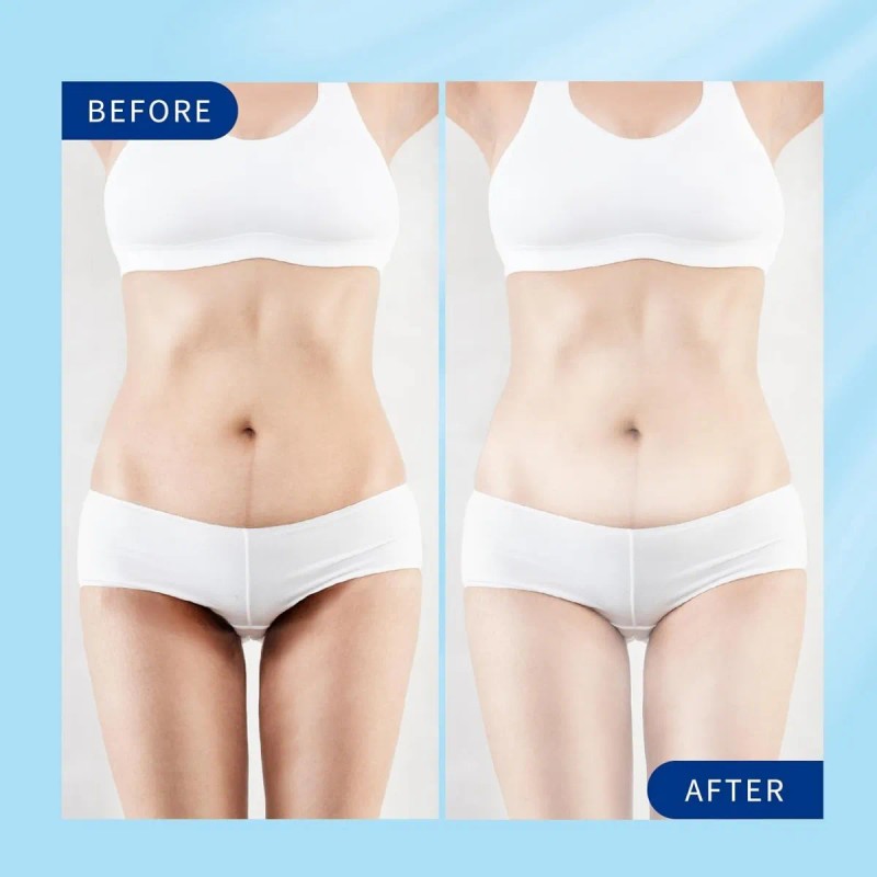 Crema Blanqueadora De Piel, Crema Blanqueadora Íntima Para M