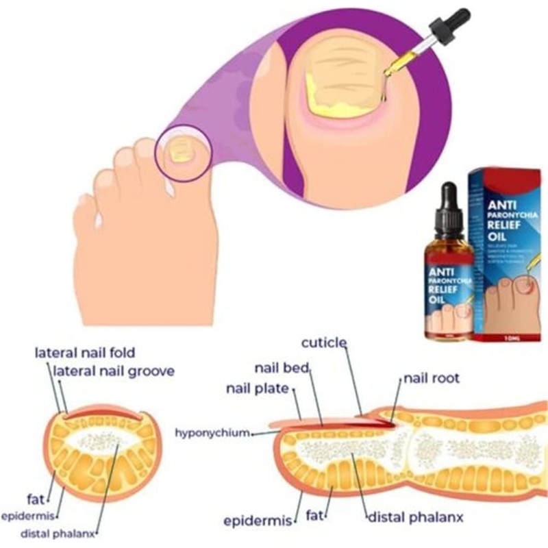 Tratamiento MFFIKOZZ para Uñas Dañadas, Engrosadas y Descoloridas de Pies