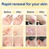 Psoriasis Cream 20g,Intensive Moisturising Cream for Very Dry, Flaky Skin