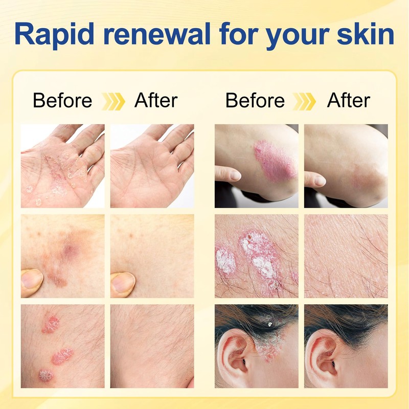 Psoriasis Cream 20g,Intensive Moisturising Cream for Very Dry, Flaky Skin