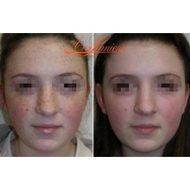 Jessner Chemical Peel Kit AHA BHA Citric Kojic and Lactic Acid Peel 1.69oz + Acid Neutralizer For Face 1.69oz Miami Acid Peeling For Face pH3 [Ane Lumiere]