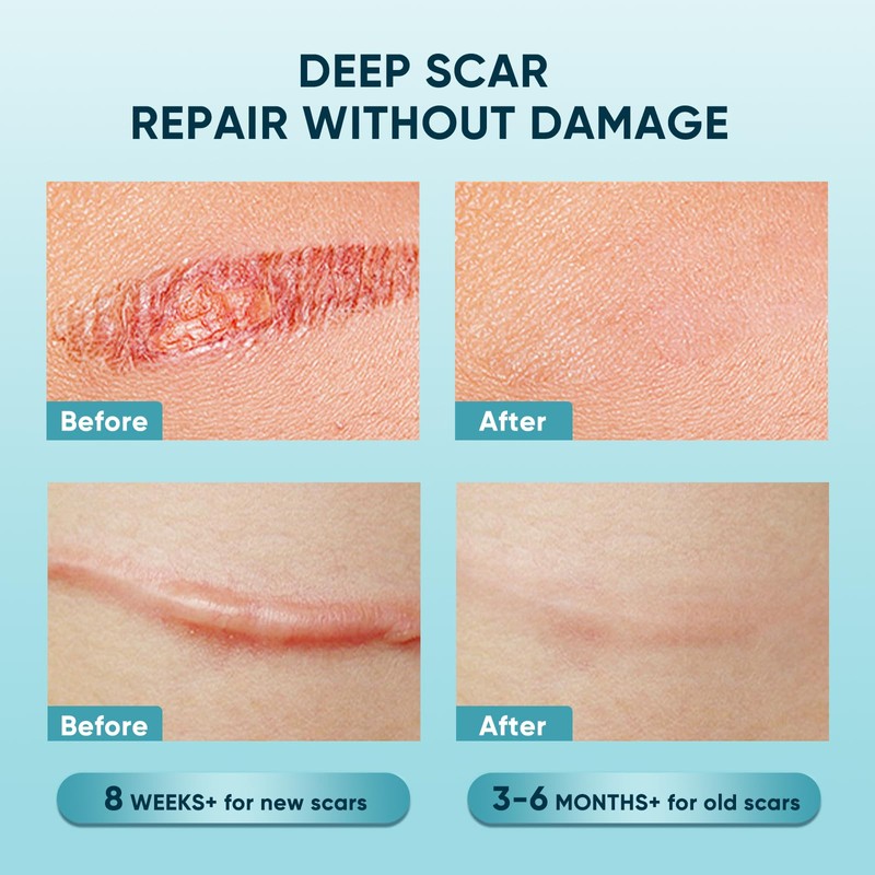 Scar Gel, Scar Cream, Advance Scar Gel for Surgical Scars