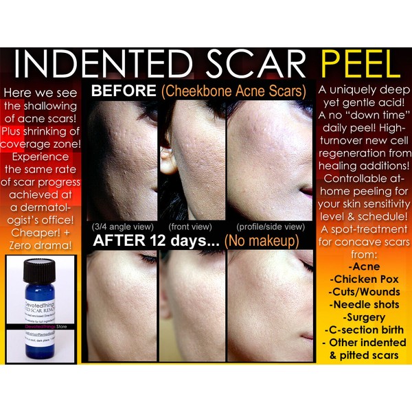 DevotedThings BEST Treatment for Indented Scars Acne Chicken Pox Pitted
