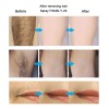 Bikini Para Barba Permanente, Inhibidor Del Crecimiento Del