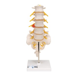 3B Scientific Human Anatomy - Lumbar Spine with Dorsolateral Herniated Disc + Free Anatomy App - 3B Smart Anatomy
