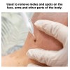 Herramienta Para Quitar Verrugas Condilomas Vph Zona Bikini