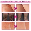 Hppsctink Butt Acne Cream, 100 ml Butt Acne Cream Reducing