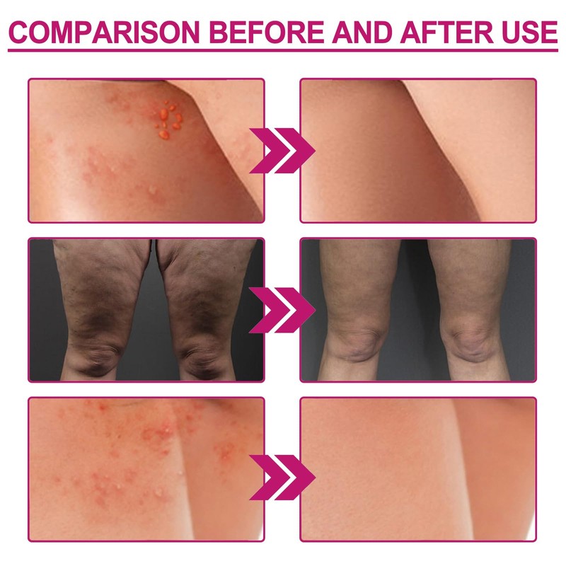 Hppsctink Butt Acne Cream, 100 ml Butt Acne Cream Reducing