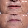 Wrinkles Schminkles Mouth & Lip Wrinkle Patch - Reusable Silicone