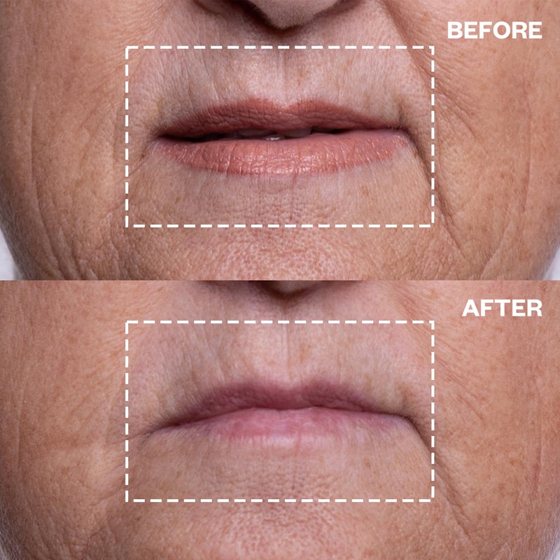 Wrinkles Schminkles Mouth & Lip Wrinkle Patch - Reusable Silicone