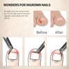 FERYES Toenail Clipper Straight Blade for Ingrown and Thick Nails