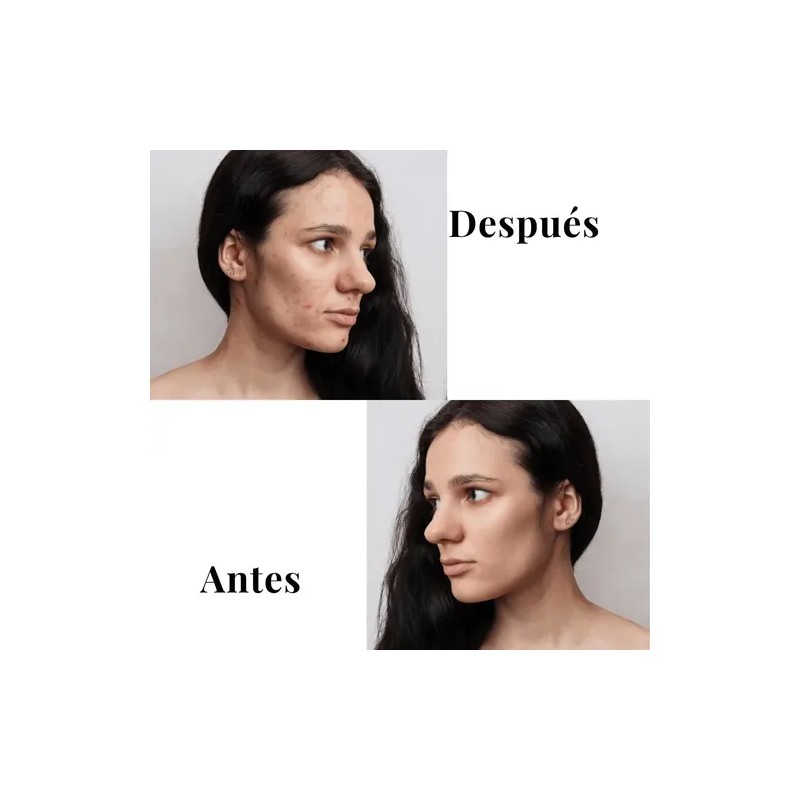 Kit Tratamiento Acné Lilo Skincare Té Verde Y Niacinamida