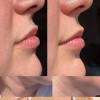Brandluxe Dermaplaning Refills for Face, Eyebrow Shaping, Gentle Hair Removal