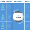 viraball Physiotherapy Vibration Therapy Ball - Physical Therapy for Hand