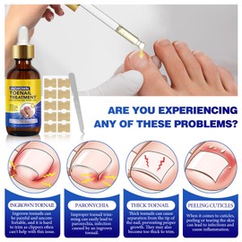 Ingrown Toenail Treatment, 60ml Ingrowing Toenail Kit, Ingrow Toenail Corrector, Anti Ingrow Nail Cuticle Care Oils for Trimming Toenail Softening Drops with Nail File & 10Pcs Toenail Corrector Patch