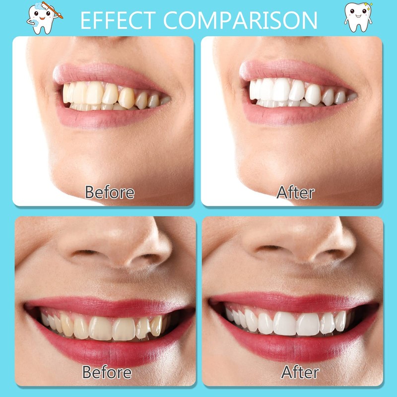 False Teeth Veneers, Veneer Teeth Cosmetic Tooth Cover Fake Teeth