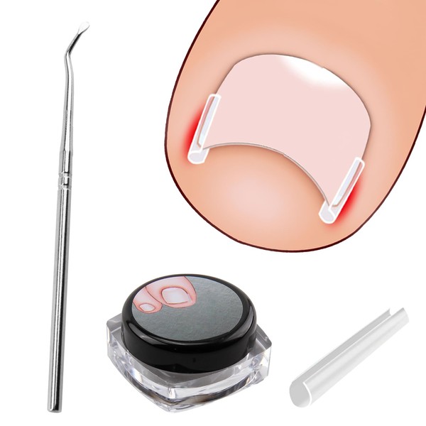 Ingrown Toenail Correction Kit, Ingrown Toenails, 40 Pieces Painless Toenail
