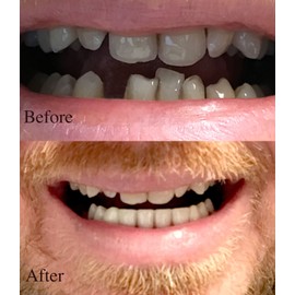Instant Smile Professional Cosmetic Lower Teeth - New from Hand crafted detail, custom fit at home!