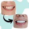 Dientes Postizos Temporal Sonrisa Dental Carilla