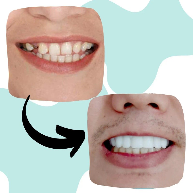 Dientes Postizos Temporal Sonrisa Dental Carilla