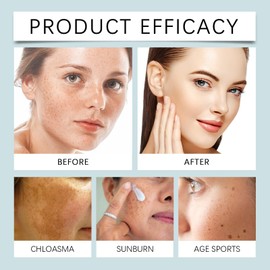 Dark Spot Remover for Face&Body,Dark Spot Correcting Cream,Dar/k Sp/ot Remover,Pigmentation Removal,Da/rk Spo/t Corrector Cream,Freckle Removel Crea/m,Hyperpigmentation Treatment Mela-Sma Cr/eam