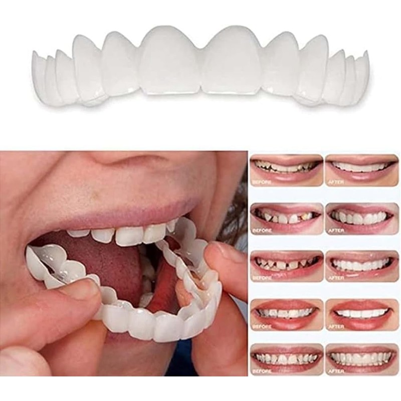 Adjustable Smile Supports - 2 Pairs (Top & Bottom) |