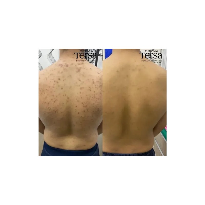 Crema Despigmentante Quita Manchas Acné Paño Vitíligo De 30g