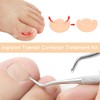 77 Pieces Ingrown Toenail Tool Set, Include Ingrown Toenail File