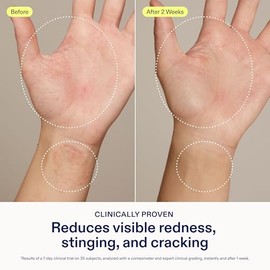 Skinfix- Crema para aliviar el eccema de las manos: crema hidratante reparadora para tratar el eccema y las manos secas, agrietadas y sensibles.