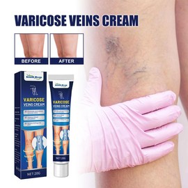 South Moon Vein Massage Varicose Cream Repair Earthworm Legs To Relieve Leg Blood Vessel Bulge And Varicoidea Care Moisturizer