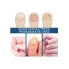 32 Parches Reparacion Uñas Nail Hongos Extracto De Hierbas F